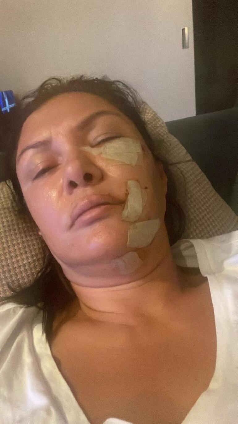 Şilede köpek saldırısına uğrayan şarkıcı Tuğba Altıntopun yüzüne dikiş atıldı
